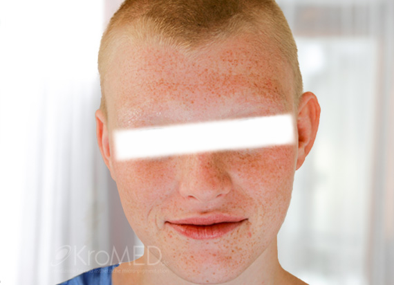 KroMED | Trichotillomanie – Augenbrauen Permanent Make-up. Das Bild zeigt ein Gesicht ohne Augenbrauen, das durch selbstzerstörerisches Haarezupfen im Rahmen der Trichotillomanie gezeichnet ist. Diese Störung der Impulskontrolle führt dazu, dass Betroffene, häufig auch Kinder, ihre Augenbrauen und Wimpern ausreißen, besonders in stressanfälligen Momenten. Die Ursachen der Trichotillomanie sind vielfältig, oft verbunden mit emotionalen Belastungen. Um das Selbstwertgefühl wiederherzustellen, entscheiden sich manche für schmerzloses Augenbrauen Permanent Make-up oder Micro Haarpigmentierung, wie es bei KroMED in Hamburg angeboten wird. Diese kosmetischen Eingriffe helfen, den sichtbaren Folgen der Trichotillomanie entgegenzuwirken.